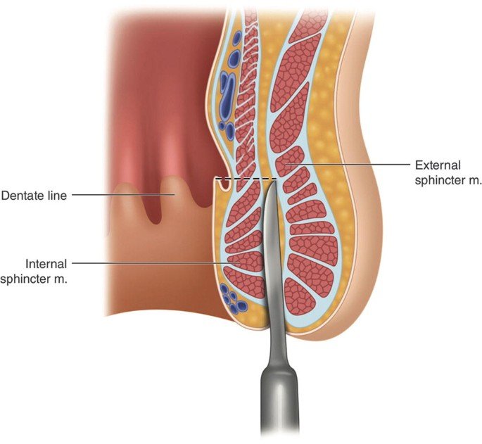 fistula treatment doctors in east Delhi