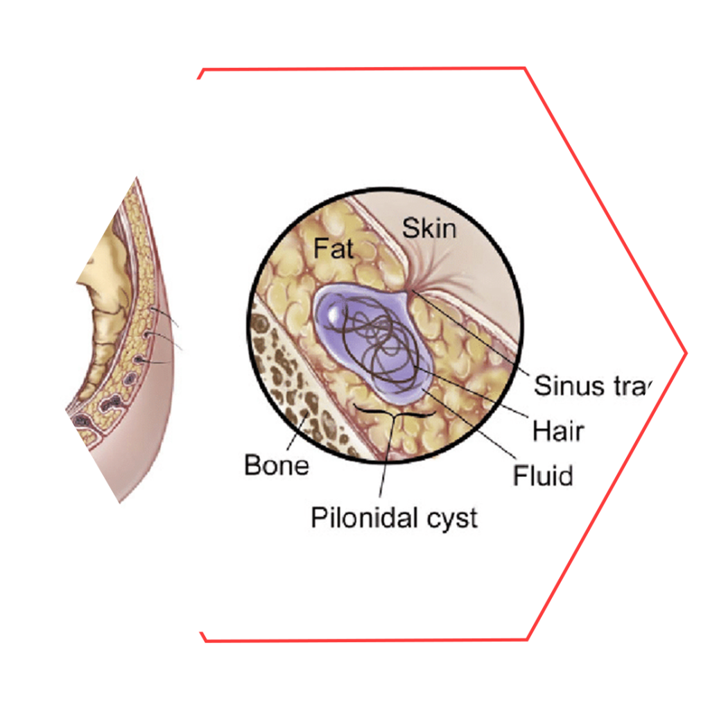 pilonidal sinus treatment in Delhi