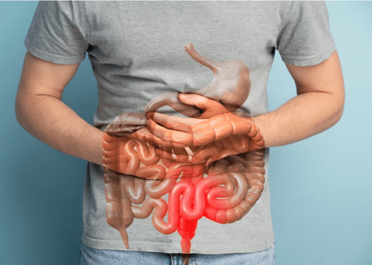 Best fissure treatment in delhi