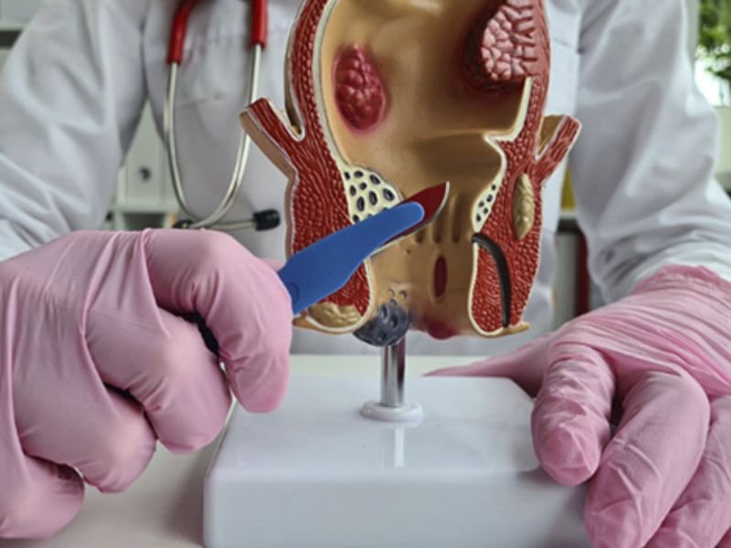 Ksharsutra Treatment for Fistula